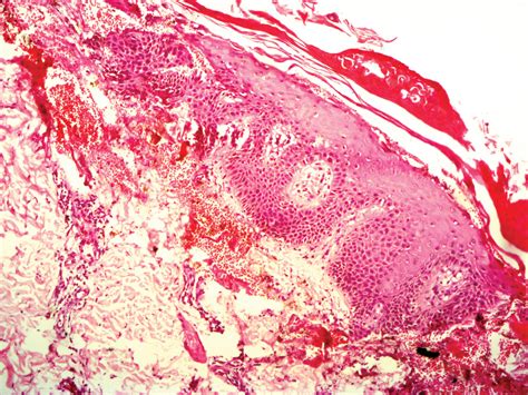 Netherton Syndrome: An Atypical Presentation | MDedge Dermatology