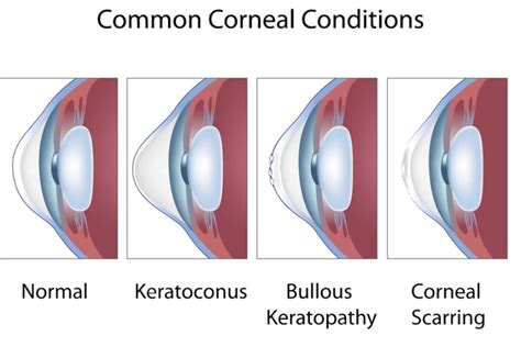 The Cornea and Its Function - Definition & Anatomy - The Eye News