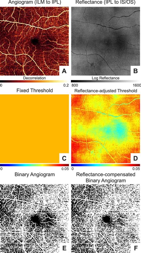 An example of the macula in a right eye to show the improvement in ...