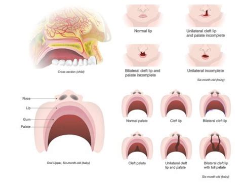 What Causes Cleft Lips and Palates? - Dell Children's Craniofacial Team of Texas