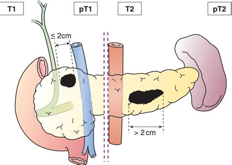 NEUROENDOCRINE TUMOURS OF THE PANCREAS | Oncohema Key