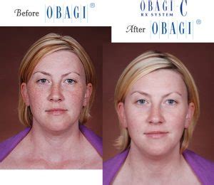 Obagi® Before and After Pictures – Micki Ly M.D. Maui Dermatologist