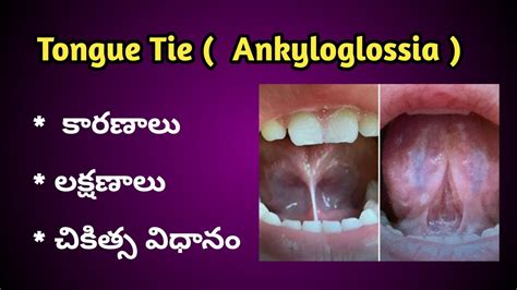 Tongue Tie | Ankyloglossia Causes, Symptoms and treatment in Telugu. - YouTube