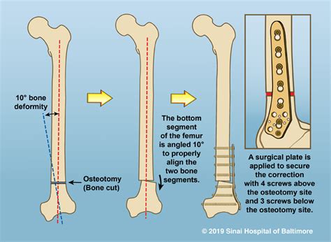 Deformity Correction: The Process | International Center for Limb Lengthening