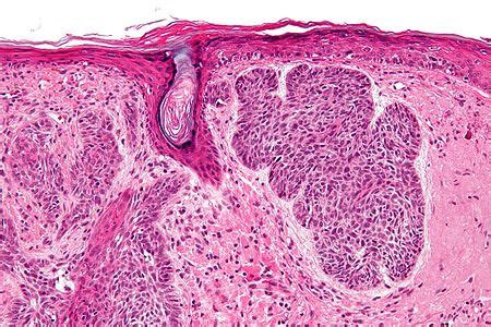 Basal cell carcinoma - Libre Pathology