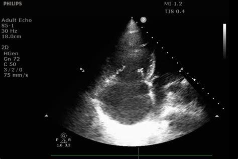 Differentiating Acute Versus Chronic Right Heart Failure with Bedside ...