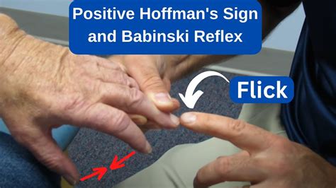 Positive Hoffman's Sign and Babinski Reflex in an MS Patient - YouTube