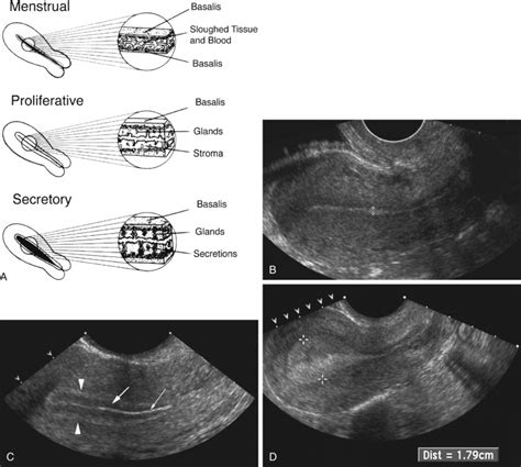 Ultrasound Evaluation of the Uterus | Radiology Key