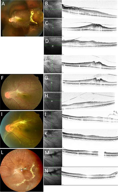 Fundus photographs and OCT images of the left eye. At initial ...