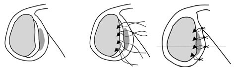 Bankart Lesion | Shoulder Instability | Shoulder Separation - Peter Millett MD | Orthopedic Knee ...