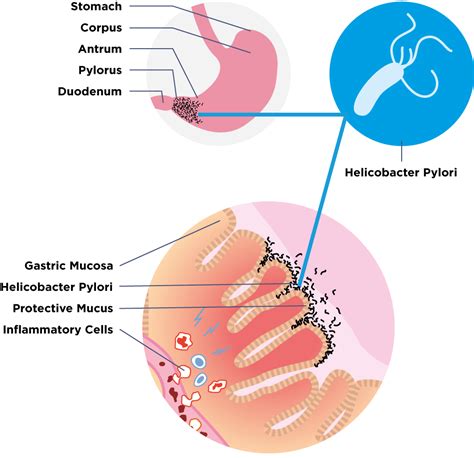 Helicobacter pylori - Guts UK