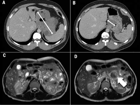 A contrast-enhanced computed tomography scan of the abdomen showing: a ...