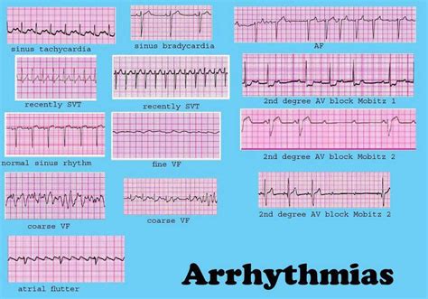 Cardiac Dysrhythmia (also Known As Arrhythmia And Irregular Heartbeat) - Electrocardiogram ...