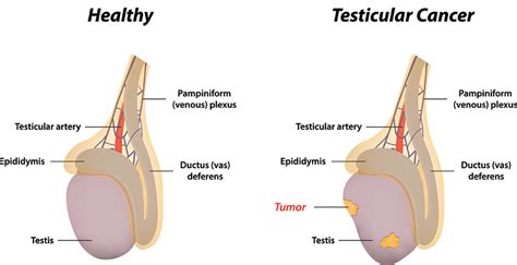 Testicular Cancer Sioux City | Siouxland Urology North Sioux City