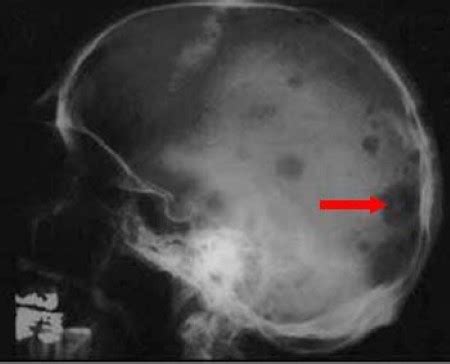 Multiple Myeloma X Ray