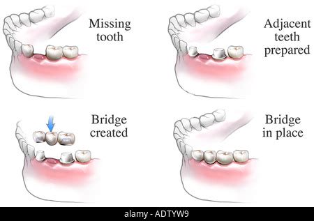 Dental bridge procedure Stock Photo - Alamy