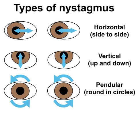 Nystagmus (flickering eye movements) in a dog - PDSA