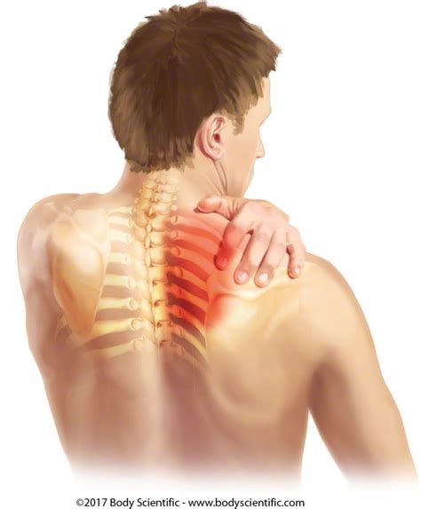Neck Pain, Upper Back Pain, Shoulder Pain? Could it be Thoracic Outlet Syndrome? - Thoracic ...