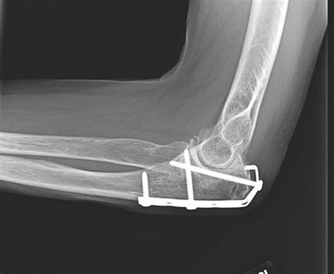 Fractures of the Olecranon and Proximal Ulna - Cancer Therapy Advisor