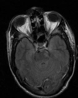 Diffuse Axonal Injury-MRI - Sumer's Radiology Blog