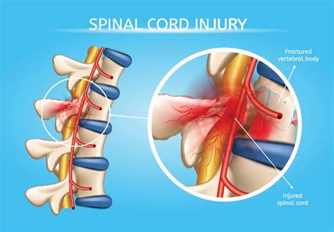 Spinal Cord Injuries - Diller Law Personal Injury Law