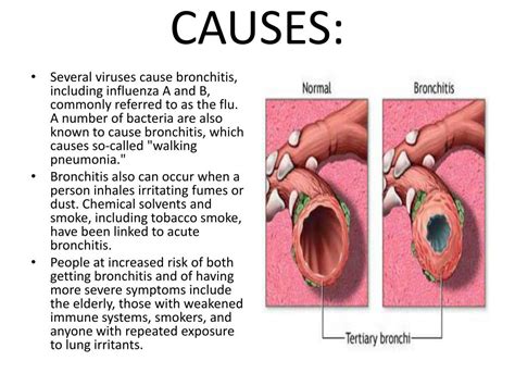 PPT - BRONCHITIS PowerPoint Presentation, free download - ID:1857430