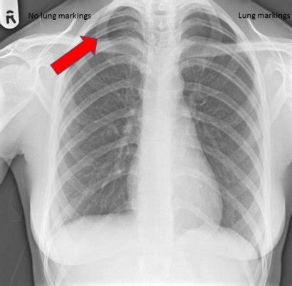 Test Yourself - Regular Sets - SET 28 - Emergency Department - Chest Radiographs - Radiology Courses