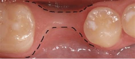 Reducing Alveolar Ridge Resorption after Tooth Extraction - ARIADentalEd