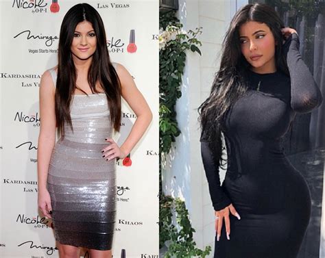 Kylie Jenner Before and After Plastic Surgery: Lips, Face, Body