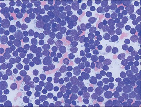 Pediatric Acute Lymphoblastic Leukemia: From Diagnosis to Prognosis