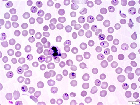 Plasmodium Malaria Slide