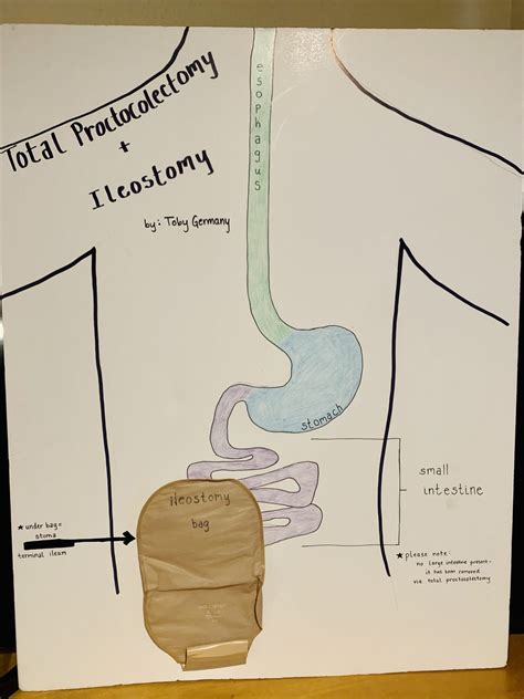 Total Proctocolectomy with Permanent Ileostomy – Human STEAM