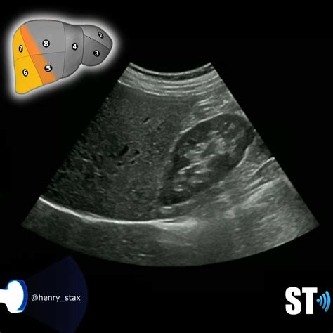 Couinaud’s Liver Segments – Sonographic Tendencies | Segmentation ...