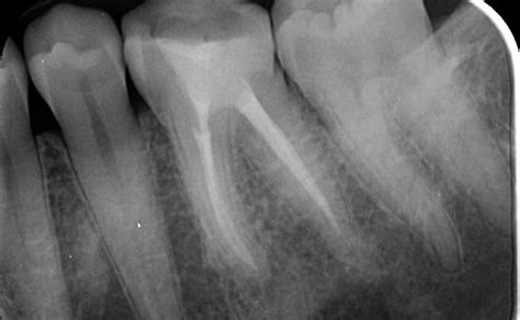 Root Canal Retreatment - Andy Tsai Endodontics