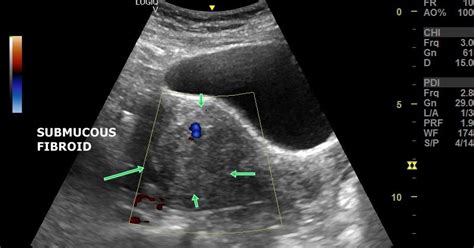 Ultrasound imaging: Sonography-submucosal-fibroid