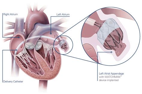 Atrial Appendage Closure | Duncanville, TX | Premier Cardiovascular