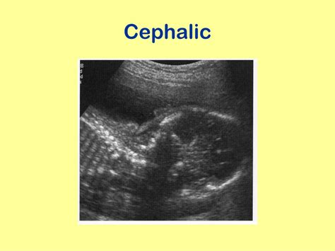 PPT - Obstetric Ultrasound Scanning Technique PowerPoint Presentation - ID:9397299