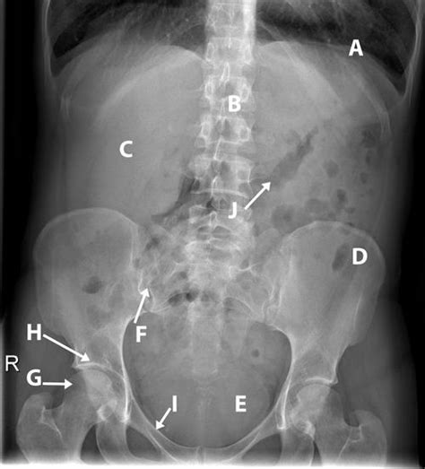 Interpreting abdominal radiographs | The BMJ