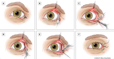 Single-Stage Repair of Paralytic Ectropion Using a Novel Modification ...