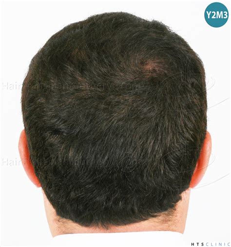 A very nice vertex work again | Hair loss Forum - Hair Transplant forums