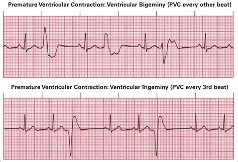 Premature Ventricular Contractions Pvcs Ecg Review Learn The Heart | SexiezPicz Web Porn