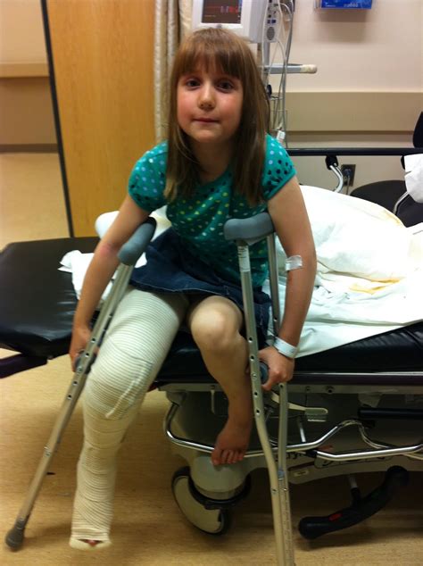 Broken Leg Cast Amputee