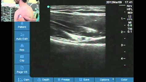 Axillary Nerve Block