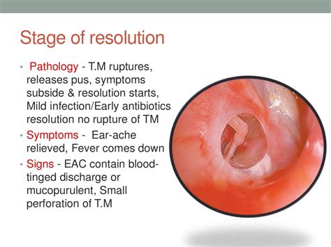 Acute otitis media