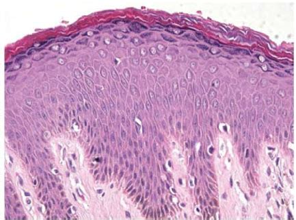 (A) Spindle cell melanoma (arrow) with fibrosis adjacent to the... | Download Scientific Diagram