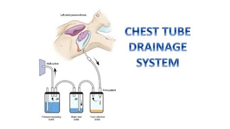 Managing CHEST TUBE DRAINAGE SYSTEM - YouTube