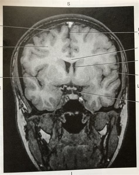 Coronal T1 MRI Cerebral Cortex & Corpus Callosum Diagram | Quizlet