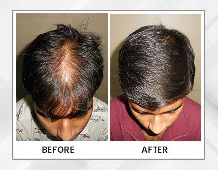 Hair loss treatment in Kolkata - hair treatment in Kolkata - Dr. Paul's