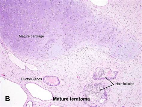 Teratoma Histology