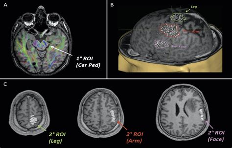 Navigated Transcranial Magnetic Stimulation for “Somatotopic... : Operative Neurosurgery